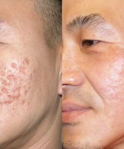 Điều trị sẹo rỗ