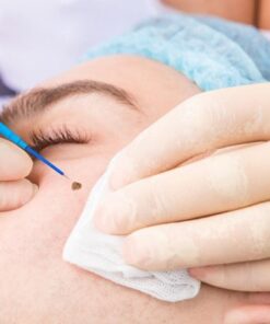Xoá nốt ruồi không để lại sẹo